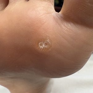 胼胝（タコ）の事例 Before