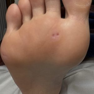 胼胝（タコ）の事例 After