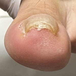 重度巻き爪の事例 Before