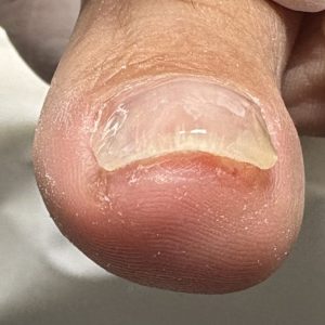 重度巻き爪の事例 After