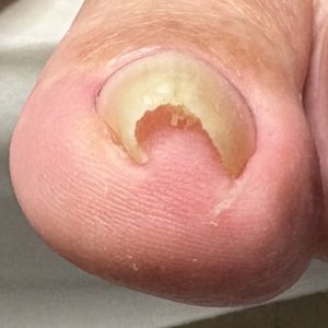 重度巻き爪の事例 Before