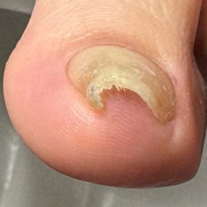 重度巻き爪の事例 Before