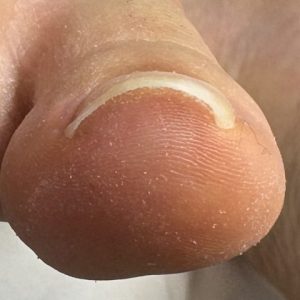 中度巻き爪の事例 Before