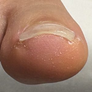 中度巻き爪の事例 After