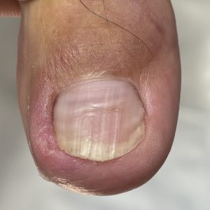 陥入爪の事例 Before