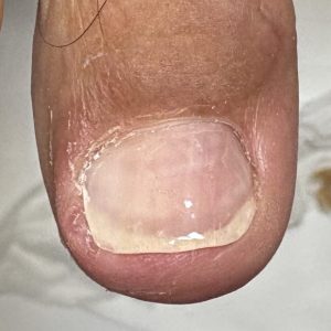 陥入爪の事例 After