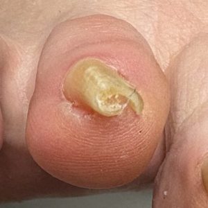 重度巻き爪の事例 Before