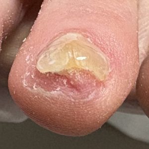 重度巻き爪の事例 After