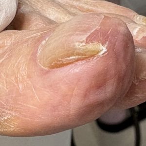 重度巻き爪の事例 Before