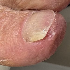 重度巻き爪の事例 After