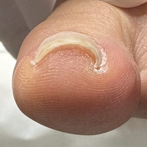 中度巻き爪の事例 Before