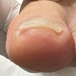 中度巻き爪の事例 After