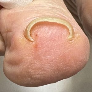 重度巻き爪の事例 Before
