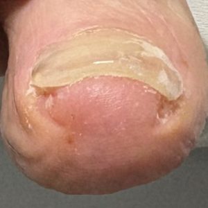 重度巻き爪の事例 After