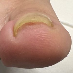 重度巻き爪の事例 Before