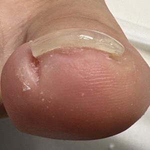 重度巻き爪の事例 After